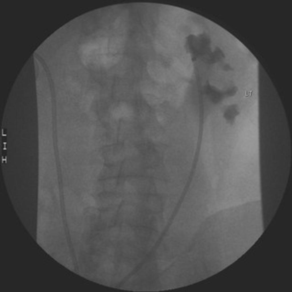 Fig. 2: Bilateral transileal ureteric stents.