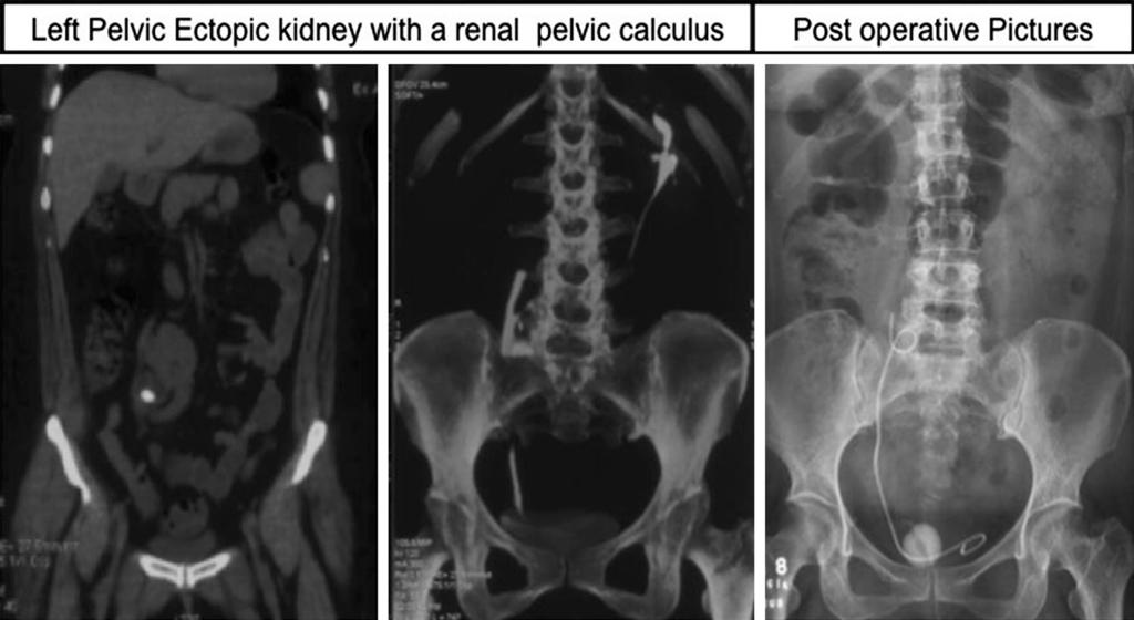 Fig. 1 Showing pelvic ectopic kidney with a renal pelvic calculus and a post-furs Xray KUB Table 1 Results Average age 38.28 ± 12.59 years Male/female 17:8 BMI (kg/m 2 ) 23.45 ± 7.