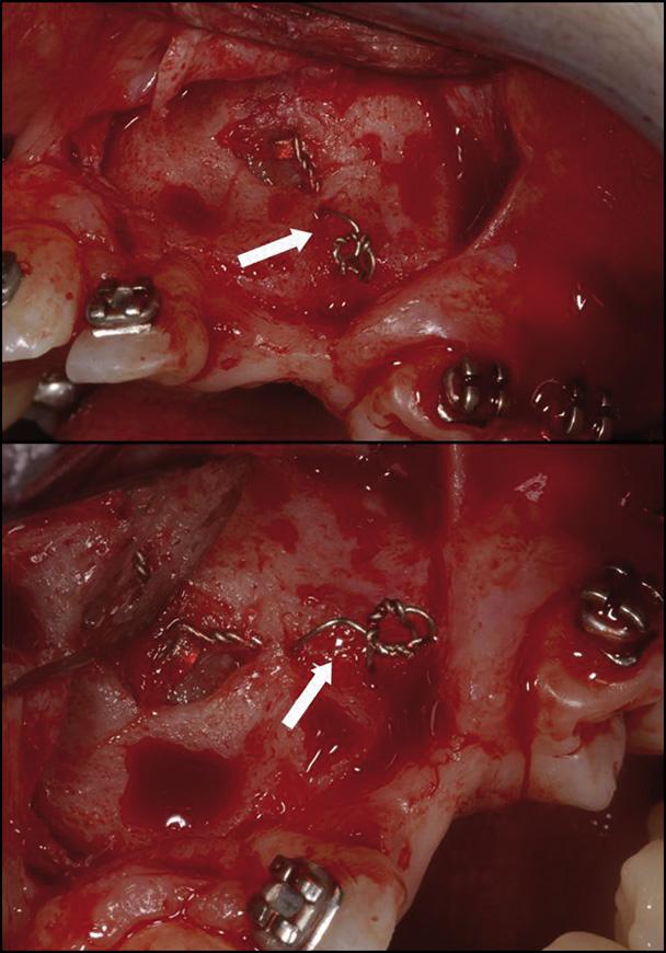 Alessandri Bonetti et al 123 Fig 3. Intraoral photographs after 6 months of active traction. Fig 4. Osseointegration of the wire chain was found when the site was reopened.