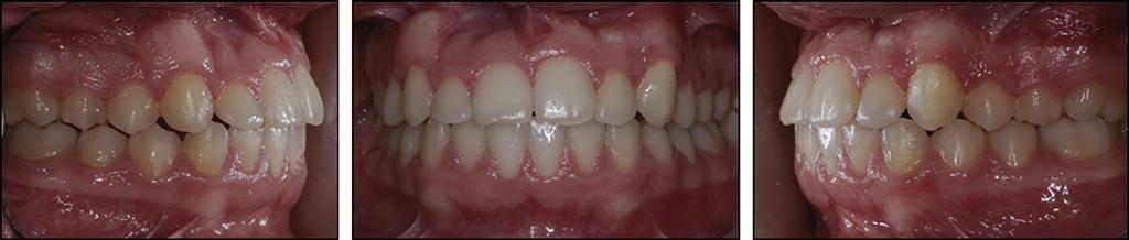 124 Alessandri Bonetti et al Fig 5. Intraoral photographs at the end of treatment. Fig 6. Panoramic radiograph at the end of orthodontic treatment.