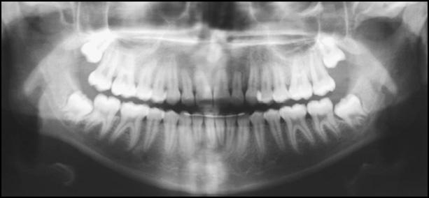 This can be attributed to a slight apical root resorption, possibly due to the preexisting permanent canine position but, also, to increased buccal inclination of the maxillary incisors. REFERENCES 1.