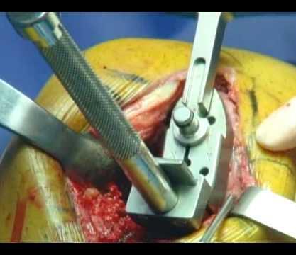 Methods: Surgical Technique Medial incision without patellar eversion Tournique utilized from incision to completion of cementing Intraoperative local injection of periarticular tissues with 20-40 ml
