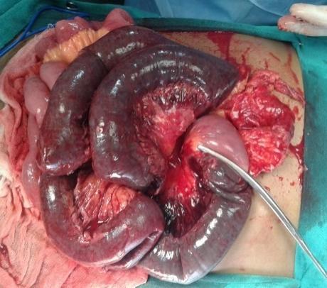 10 patients underwent gut resection and ileostomy/jejunostomy with mucous fistula while 01 patient underwent gut resection and primary anastomosis.