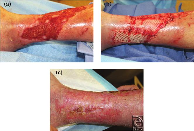 eplasty VOLUME 13 Figure 1. (a) Wound at initial presentation. (b) Wound after HADWM placement. (c) 30 days after placement of HADWM.