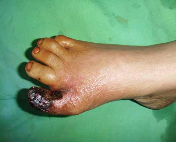Gangrene What to look for A good foot inspection will identify any changes in colour and temperature.