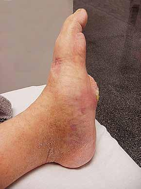 Charcot Foot Charcot foot (arthropathy) is a condition causing weakening of the bones in the foot that can occur in people who have significant nerve damage (neuropathy).