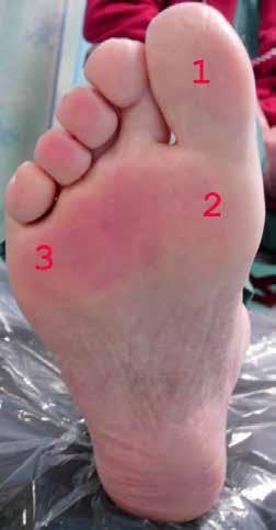 Neuropathy What to look for Lack of sensation in the feet. How to check Begin by asking if there is any history of restless legs, tightness, tingling or irritation in legs and feet.