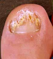 Skin and Nails Maintaining skin integrity is an essential part of good foot care for all people with diabetes. Check carefully for any changes to the skin and nails and manage accordingly.