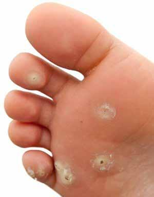 Skin and Nails What to look for Corns/Verrucae Traditional treatment for corns include Corn Plasters which are generally salicylic acid based, these are contra indicated for anyone with a risk