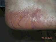 Callus Callus is included as a specific risk factor for ulceration Many studies have shown the presence of callus to increase the likelihood of ulceration, the authoritative Leese study suggests by