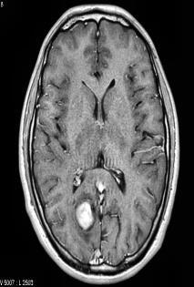8 Histogram of Original MRI image Figure 7 shows Histogram equalised MRI image. The histogram of histogram equalised image considered as modified image is shown in Figure 8.