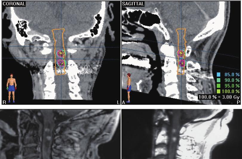 SPINAL INTRADURAL METASTASES 265 RESULTS Total doses of 24 to 36 Gy in 5 to 12 fractions were delivered to spinal intradural metastases within or adjacent to the previous irradiation field.