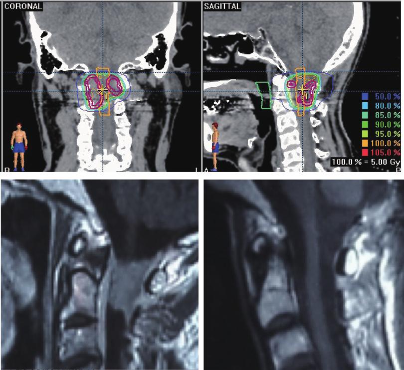 SPINAL INTRADURAL METASTASES 267 was once resected subtotally, but recurred 3 months later.