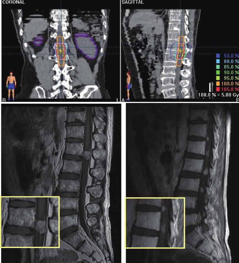268 Yoshimasa Mori et al. (A) (B) (C) (D) Fig. 5 Case 3. Coronal (A) and sagittal (B) view of treatment planning of SRT on CT.