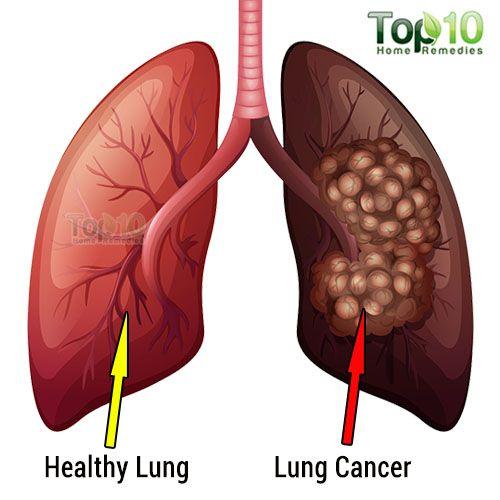 multiply and take over the healthy tissue in the lungs.