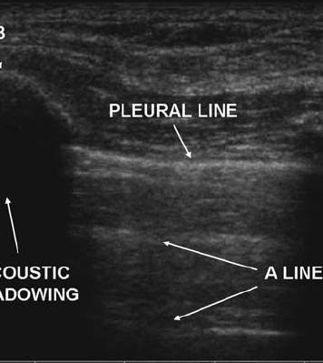 Longitudinal Scan o Pleural line - regular echogenic line - moves