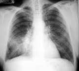 Chest Radiograph Gold Standard Chest Radiograph Gold Standard? All expert guidelines state should have positive CXR to make diagnosis History, exam, etc.