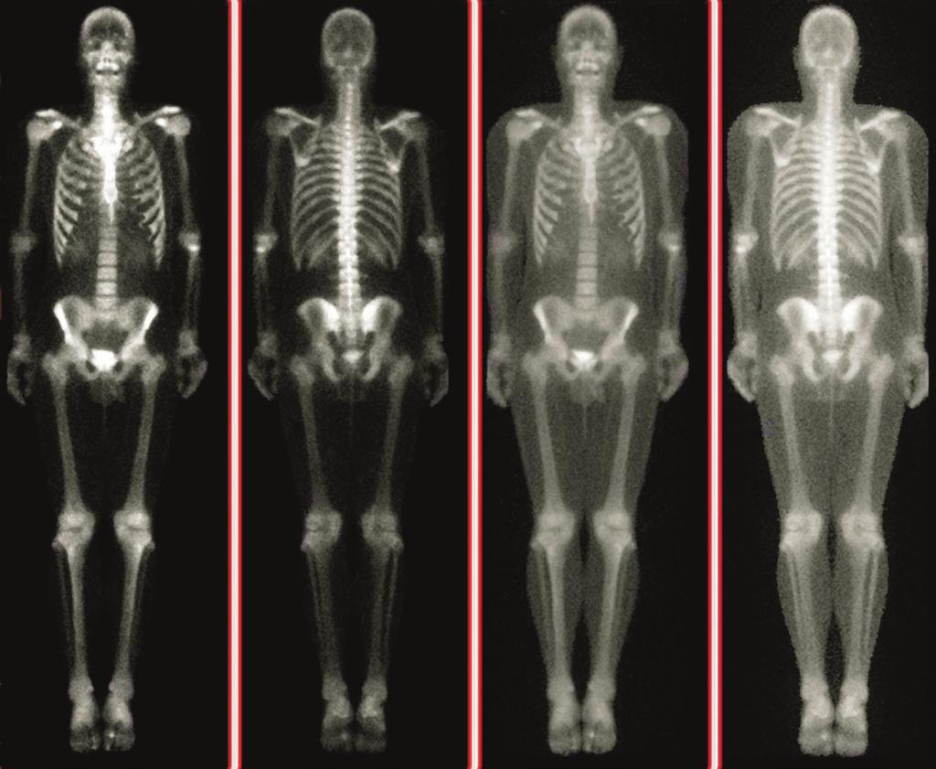 WHOLE-BODY IMAGING Whole-body imaging uses a specially designed moving detector system to produce an image of the entire body or a large body section.