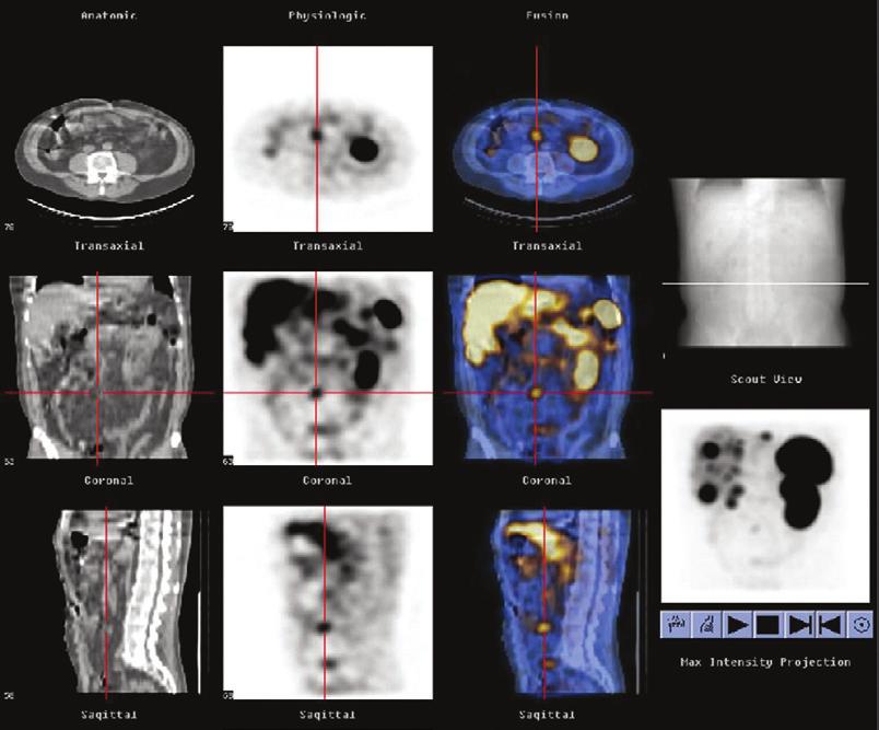 COMBINED SPECT AND COMPUTED TOMOGRAPHY IMAGING A blending of imaging function and form is available.