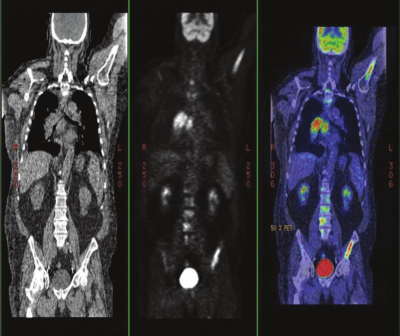 Fig. 34-33 PET FDG image with CT fusion shows large hypermetabolic right lung mass. Many PET FDG studies are done for lung cancer because of its high glucose metabolism. A B Fig.
