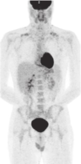 B, Image 6 months later shows profound and widely disseminated hypermetabolic metastases throughout the body.