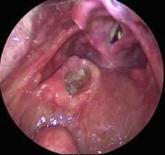 tongue Posterior pharyngeal wall Deep margins are anatomically