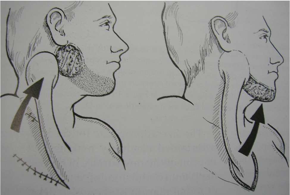 Common flaps in head and neck