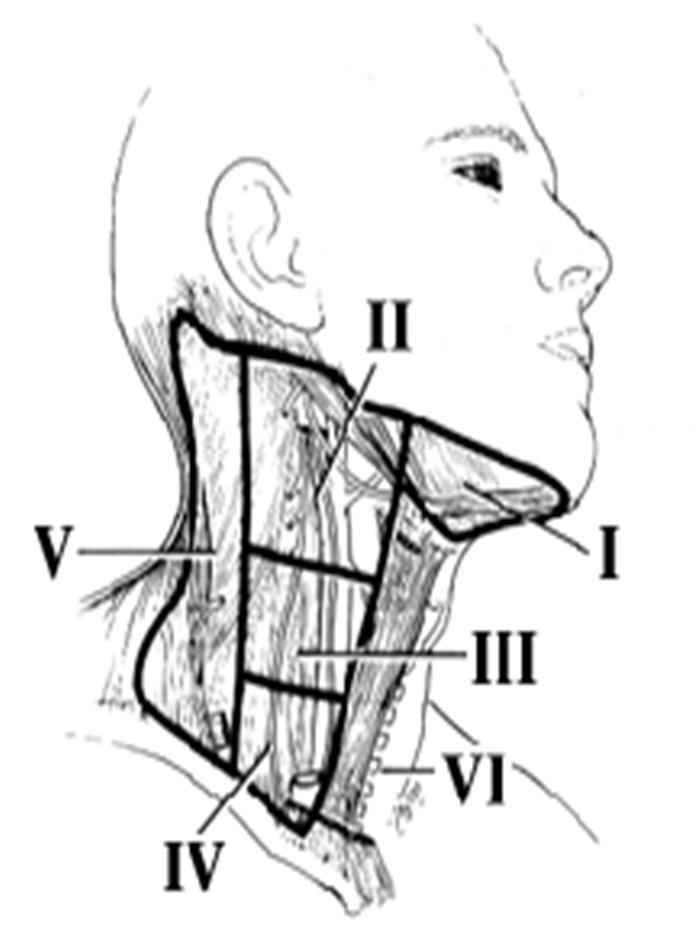 Management of neck secondaries impalpable neck nodes Supraomohyoid (1,2,3) ND: Oral cavity cancers Lateral ND