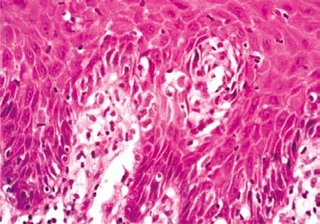 Histological section showing areas of epithelial atrophy and a layered marked lymphocytic infiltrate in the lamina propria (HE  4 Histological