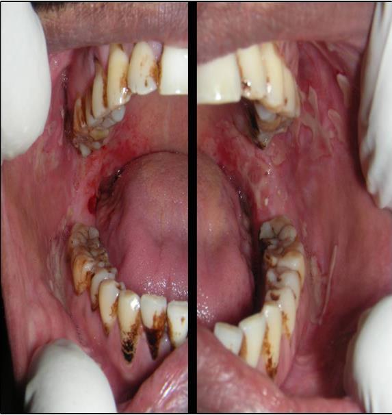 368 Ethiop J Health Sci. Vol. 25, No. 4 October 2015 ulcers in the mouth and difficulty in swallowing since 20 days, who was diagnosed as having Pemphigus vulgaris.