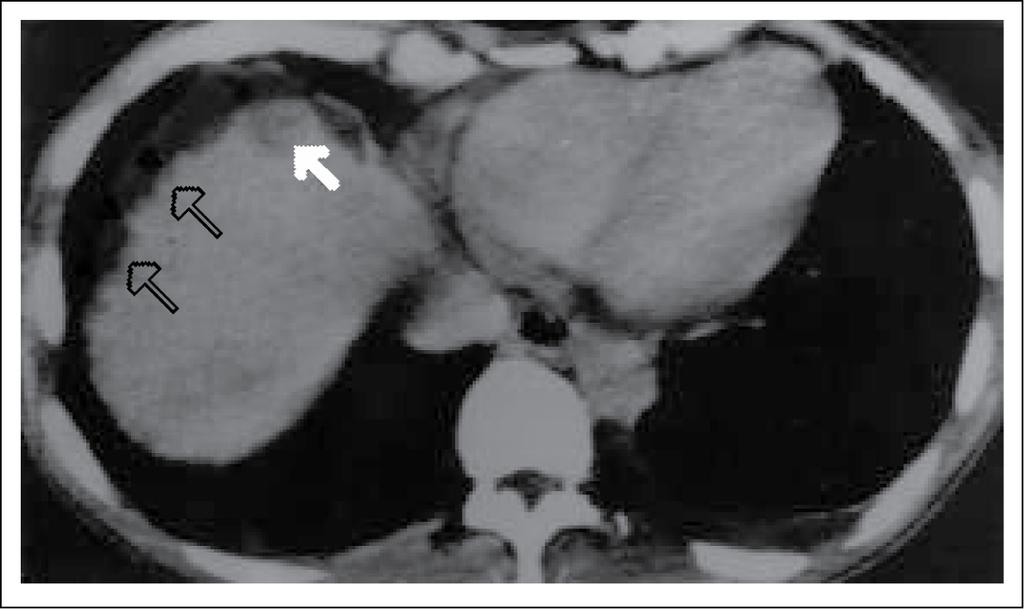 THE TRIAD OF LICHEN PLANUS, THYMOMA AND LIVER CIRRHOSIS-HEPATOMA. FIRST REPORTED CASE Fig.4 : Caption for the CT images: CT liver: Hypodense nodules in the right lobe (arrowed).