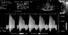 Time-to-Event Curves for the Primary End Point and Other Selected End Points. PARTNER A 3 day 1 year TAVR AVR p TAVR AVR p Stroke/TIA All 5.5 2.4.4 8.3 4.3.4 TIA.9.3.33 2.3 1.5.47 Minor.9.3.34.9.7.84 Major 3.