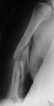 Humeral Shaft Fracture Diagnosis Fractures of the shaft of the humerus 1