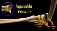fractures Occurs up to 20% of fractures 90% neurapraxias and heal in 3 4 mos Exploration indicated No recovery in 3 4 mos (clinical or EMG) Loss of function with closed reduction Open fractures