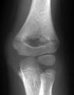 Supracondylar fractures Diagnosis Classification Type I non displaced Type II angulated but