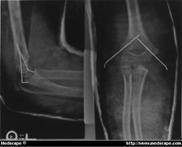 epiphyseal angle (MEE) Lateral view Humerotrochlear angle Oblique Supracondylar Fracture