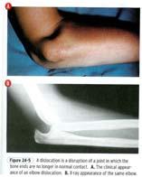 Posterior dislocation account for 80-90% Most occur without fracture Elbow