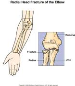 Elbow Fractures Treatment Radial Head Non displaced (type I) sling and or splint