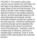 Treatment Coronoid Fracture Type 1 Immobilization for 2 weeks Type 2