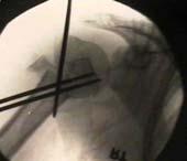 Humeral Head Fractures Treatment One part fractures (no fracture fragments displaced < 1cm or 45 deg)