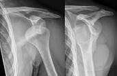 results; 10% poor Any other fracture Closed reduction with percutaneous pinning ORIF 2-6 weeks to allow pain