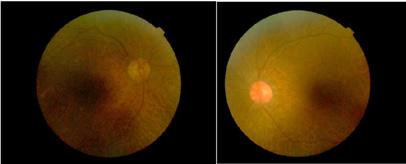 tilt reaction Ocular Tilt Reaction (OTR) - Vestibular tone imbalance in the roll plane -