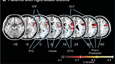 ipsilateral vesitobular nuclei Unilateral cerebellar