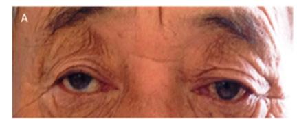 Park JY Ocular Tilt Reaction: Vestibular Disorder in Roll Plane Skew deviation : OTR DDx.