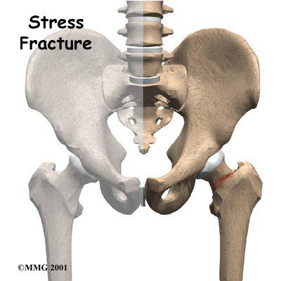 Introduction Stress fractures of the hip once most commonly affected military personnel who marched and ran day after day.
