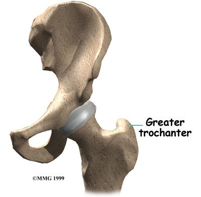 side of the bone and can cause more problems than fractures on the underside of the femoral neck.