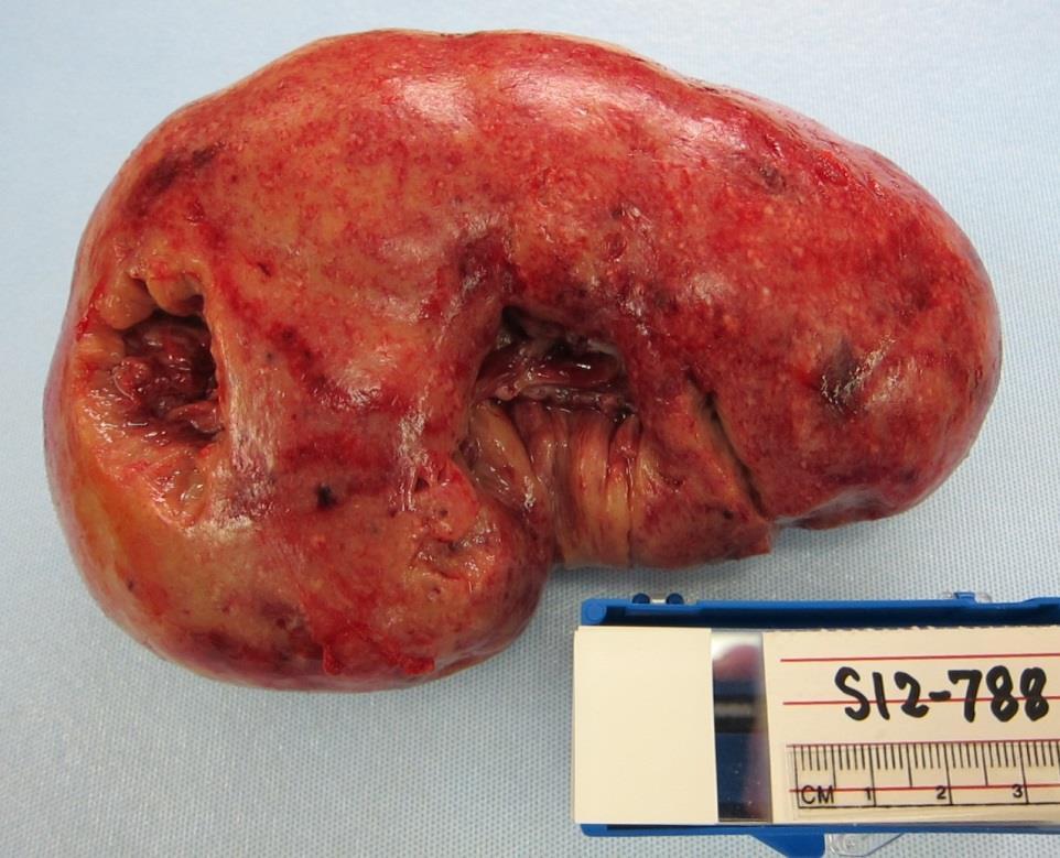 31 Left kidney