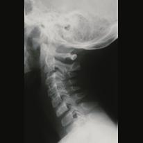 Frequent locations: Vertebra, frequently on the pedicles and spinous processes (processus spinosus) Thigh bone (femur) Neck of femur Shinbone (tibia) Upper arm bone (humerus) Incidence and