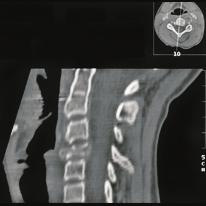 Aneurysmatic bone cyst of the cervical spine Eosinophilic granuloma (EG) Eosinophilic granulomas are usually benign granulomas that may occur in the bone,