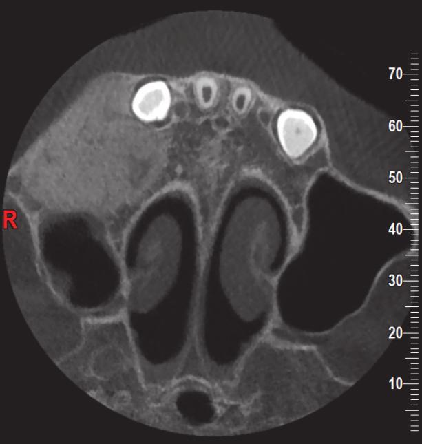 Case Reports in Dentistry 3 Figure 3: Figure showing CBCT scan: axial section showing typical granular trabecular pattern and bicortical expansion with more than half of maxillary sinus involvement